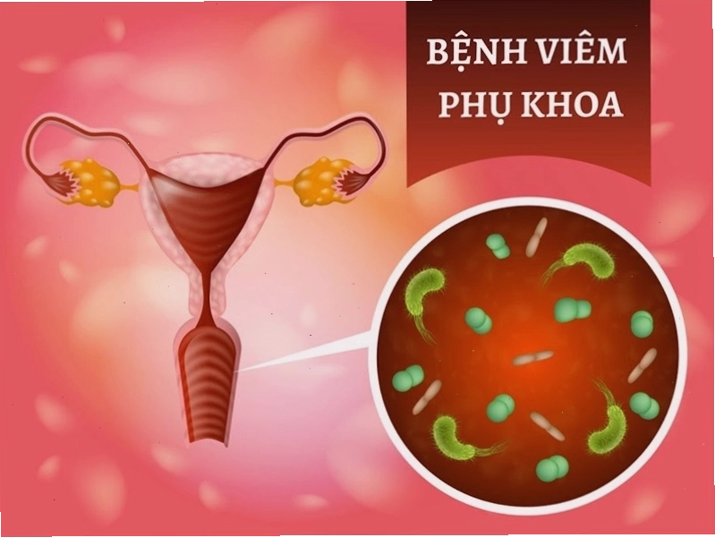 Vệ sinh vùng kín sai cách là nguyên nhân phổ biến gây viêm phụ khoa